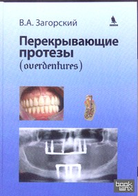 Перекрывающие протезы