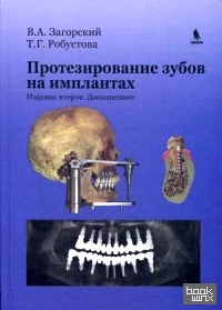 Протезирование зубов на имплантах: Руководство